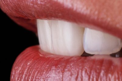 Individuell geschichtete keramisch verblendete Zirkonkrone auf Zahn 21
